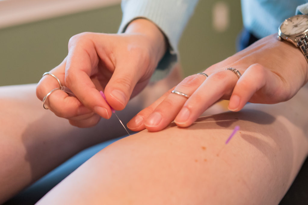 Dry Needling